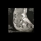 img IRM rupture du spring ligament