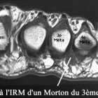 img IRM avec névrome de Morton du 3ème espace