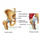 img Prothèse totale de la hanche