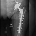 img Radiographie de reprise de prothèse totale de la hanche