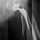 img Reprise de prothèse totale de la hanche, cause fracture 