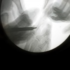 img Ostéotomie de la phalange